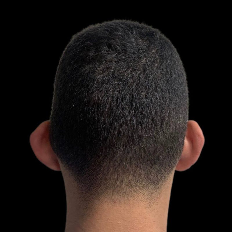 تجميل الاذنين 1-1