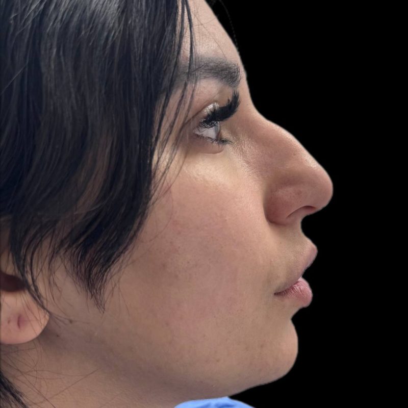 تجميل الانف 1-1