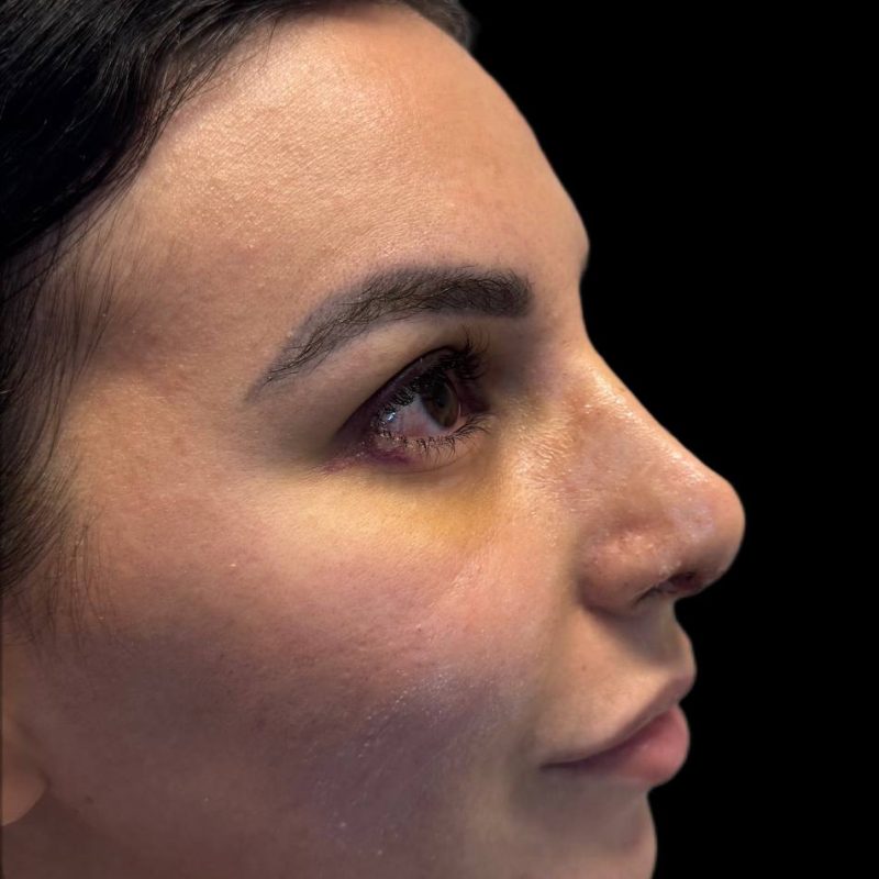 تجميل الانف 1-2