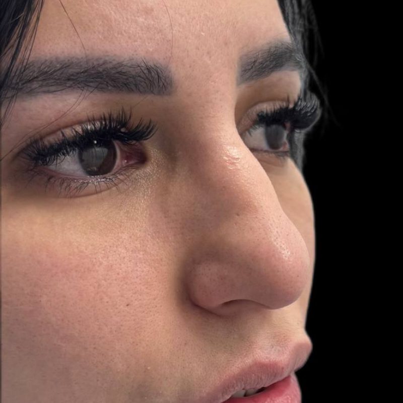 تجميل الانف 2-1