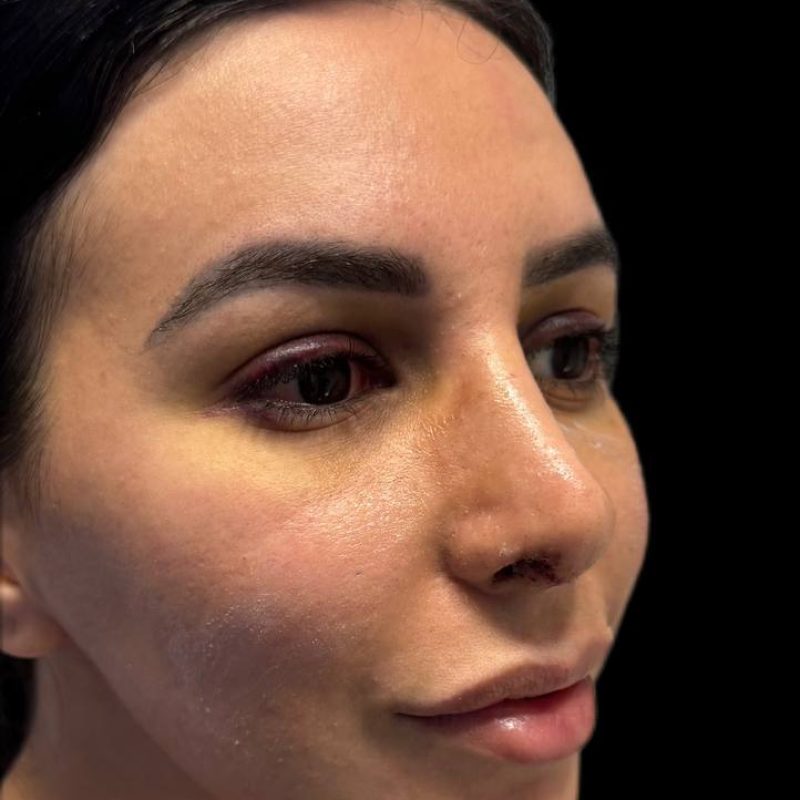 تجميل الانف 2-2