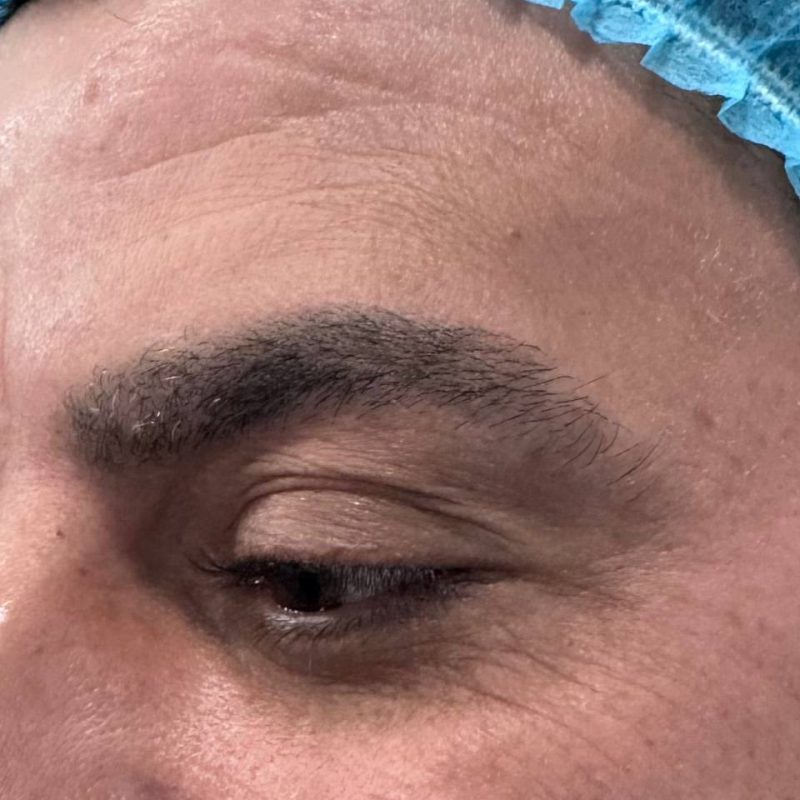 تجميل الجفون 1-1