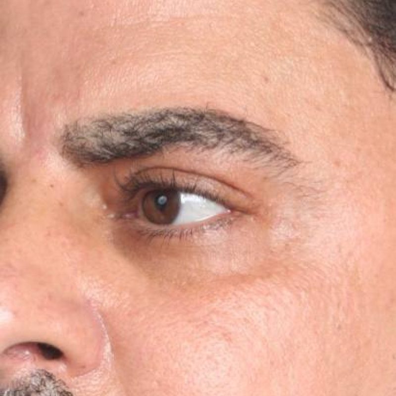 تجميل الجفون 1-2