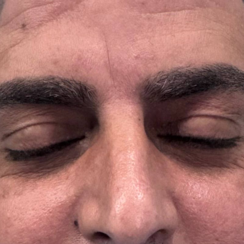 تجميل الجفون 2-1