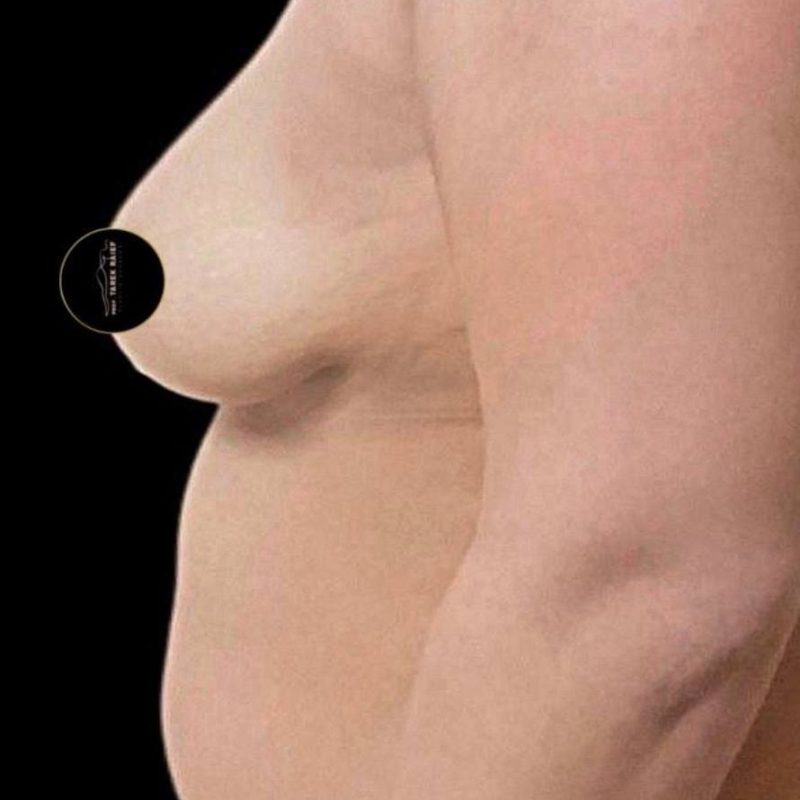 تجميل ما بعد الولادة 1-1