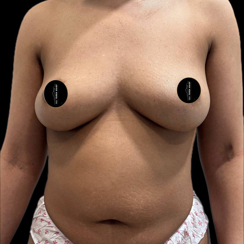 تجميل ما بعد الولادة 1-1