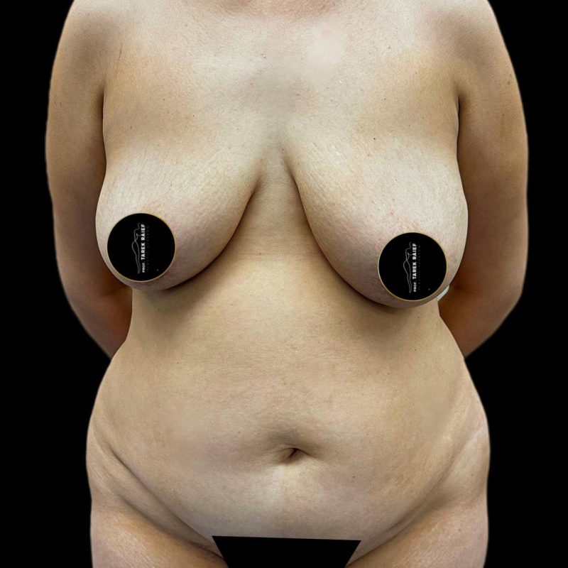 تجميل ما بعد الولادة 2-1