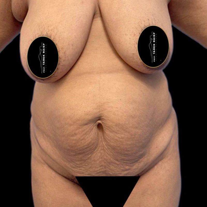 تجميل ما بعد الولادة 3-1