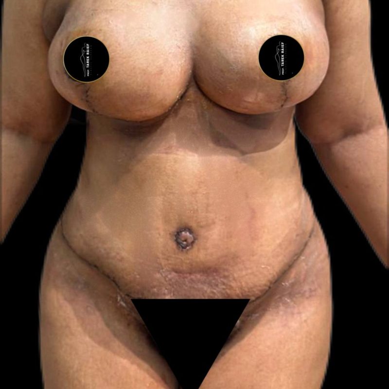 تجميل ما بعد الولادة 3-2