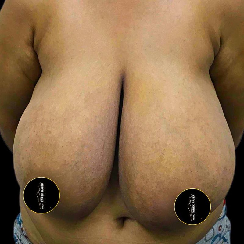 تصغير الثدي 1-1