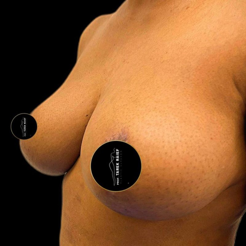 تصغير الثدي 1-2