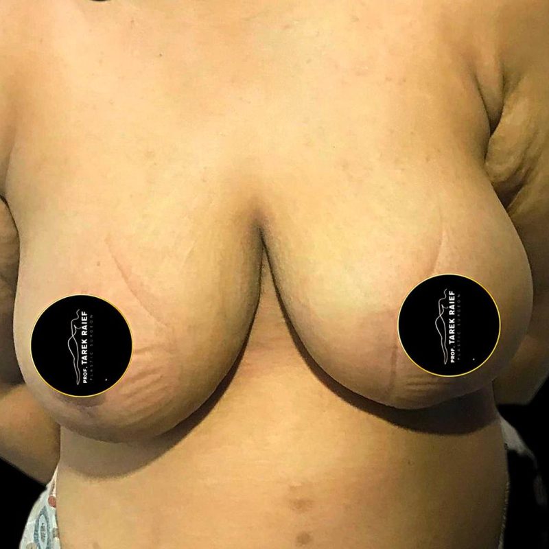 تصغير الثدي 1-2