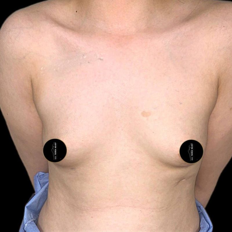 تكبير الثدي 1-1