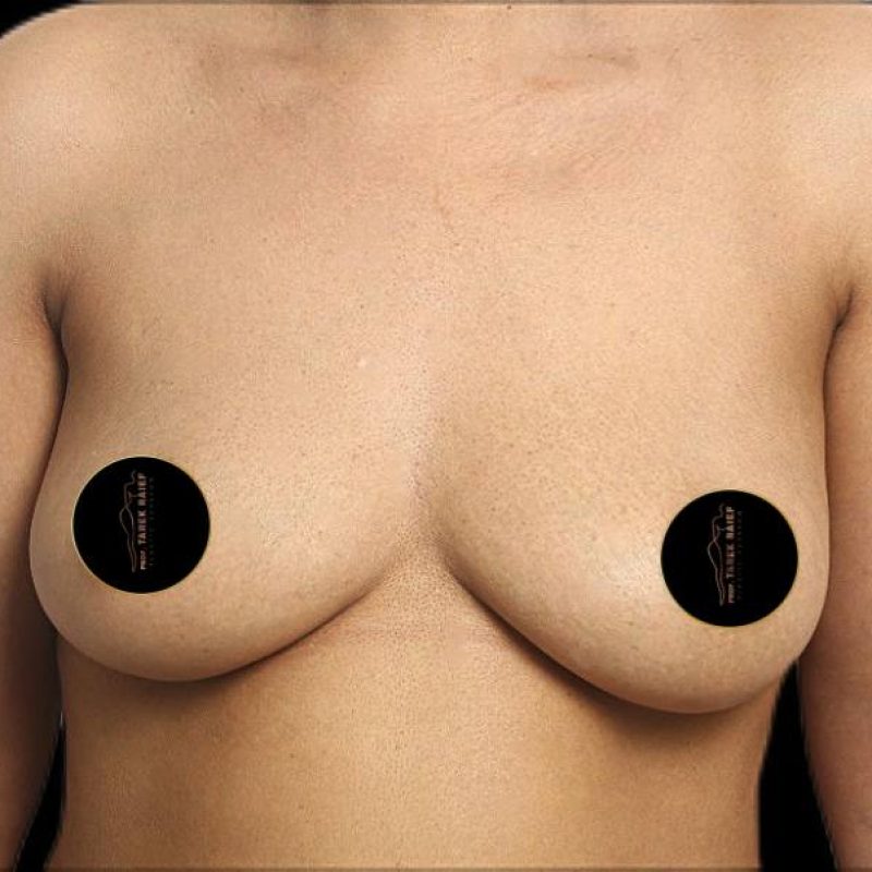 تكبير الثدي 1-1