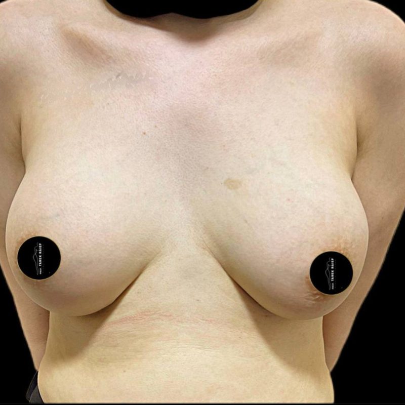 تكبير الثدي 1-2