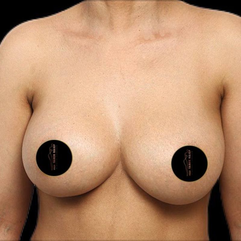 تكبير الثدي 1-2