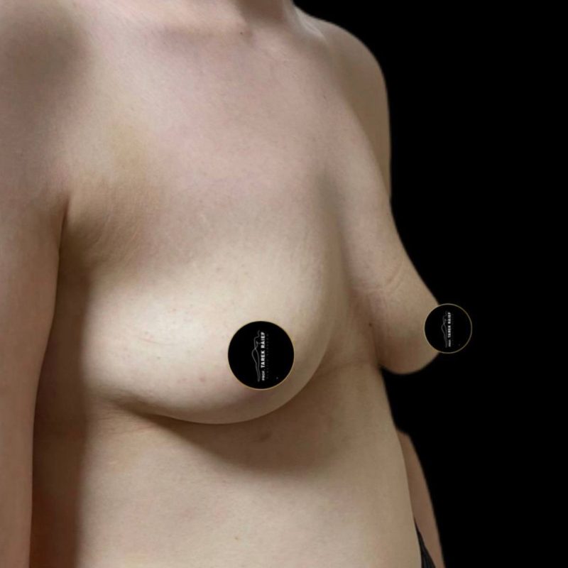 تكبير الثدي 2-1