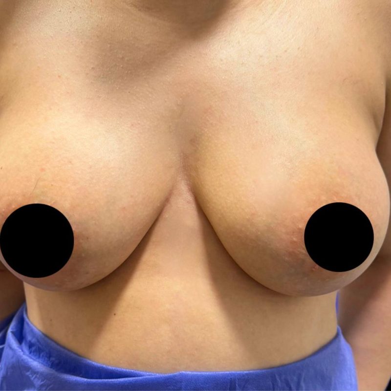 تكبير الثدي 2-2