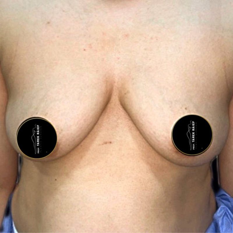 تكبير الثدي 3-1