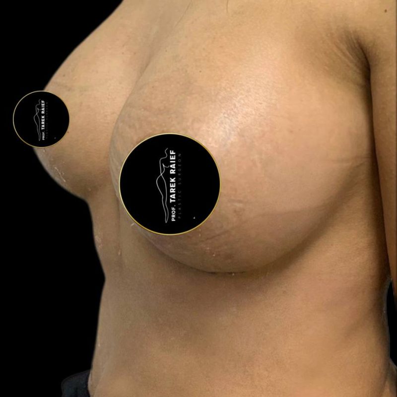 تكبير الثدي 3-2