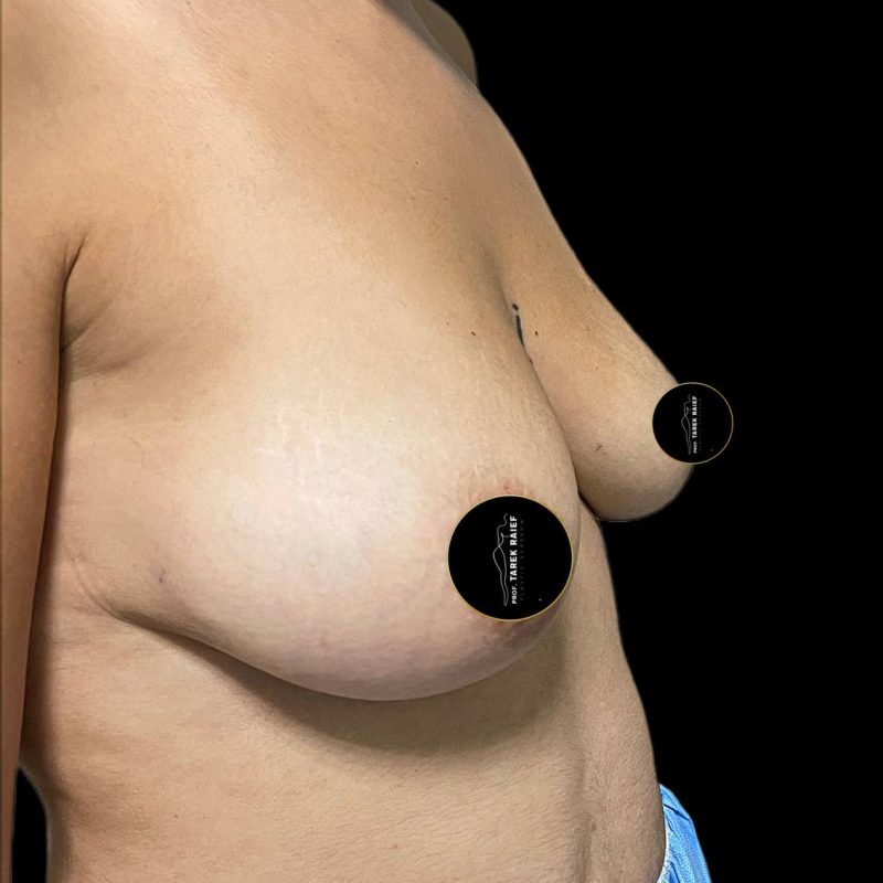 تكبير الثدي 4-1