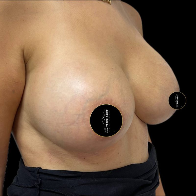 تكبير الثدي 4-2