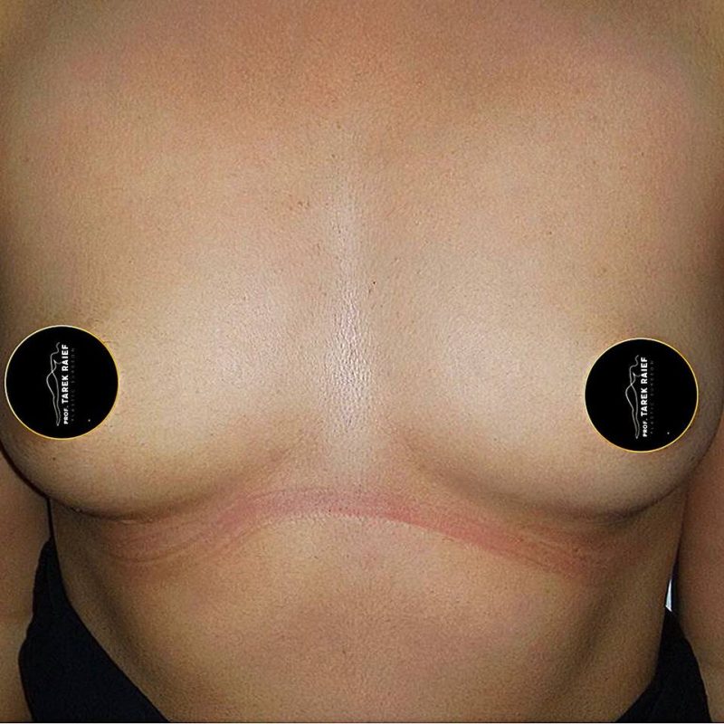 تكبير الثدي 5-1