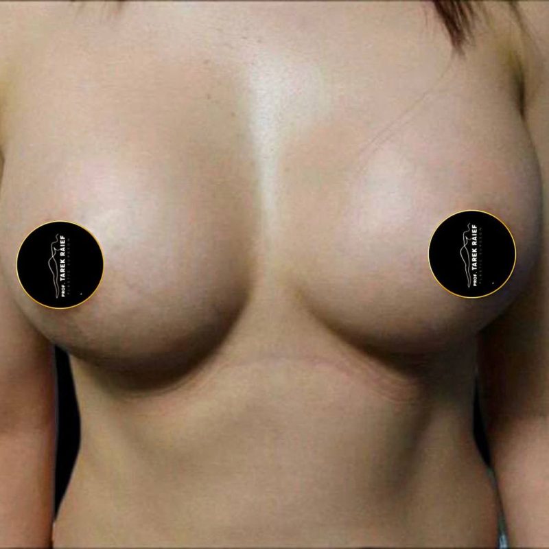 تكبير الثدي 5-2