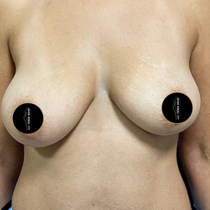 تكبير الثدي 6-1