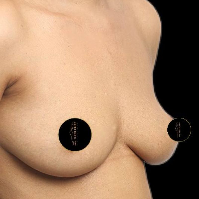 تكبير الثدي 6-1