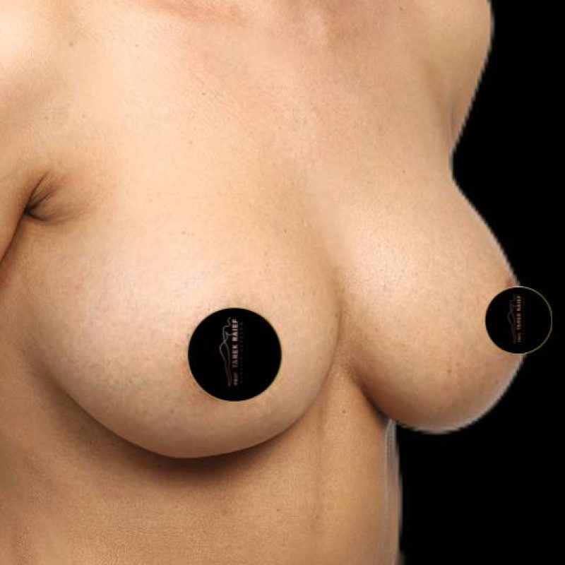 تكبير الثدي 6-2