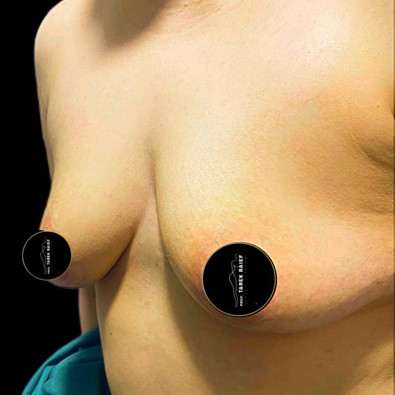 تكبير الثدي 7-1