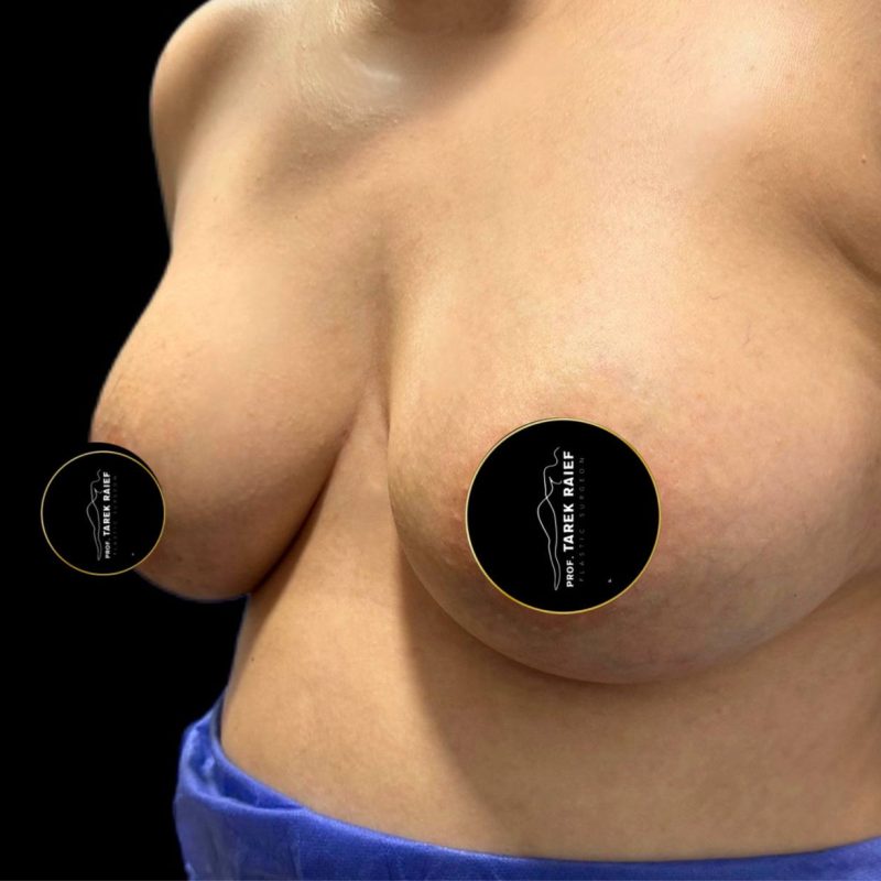 تكبير الثدي 7-2