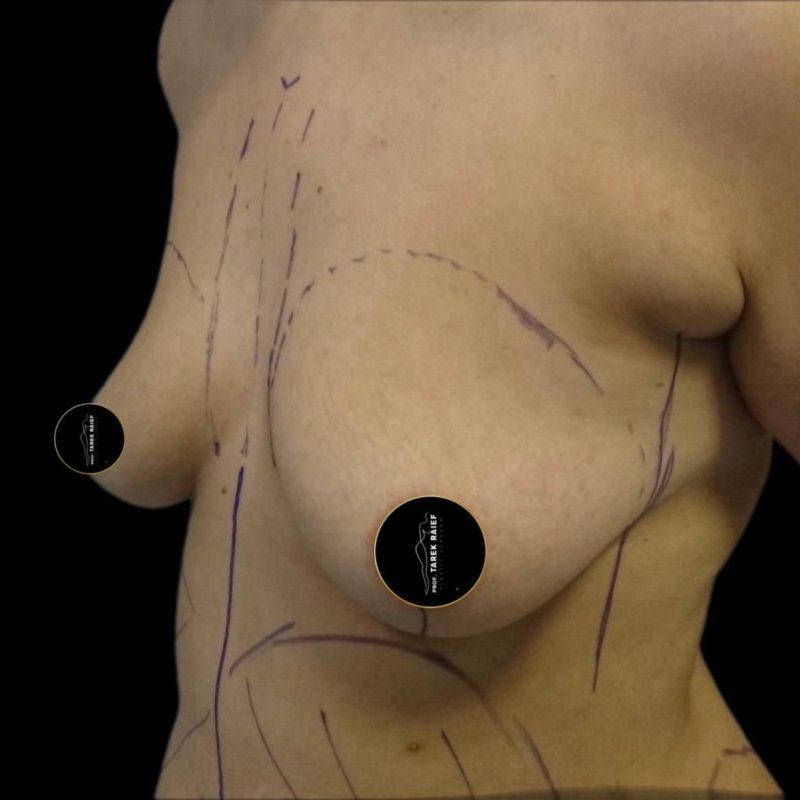 تكبير الثدي 8-1