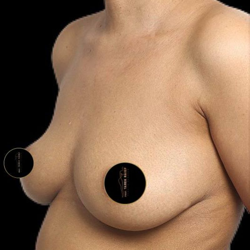 تكبير الثدي 8-1