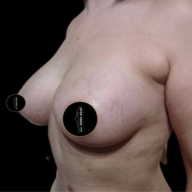 تكبير الثدي 8-2