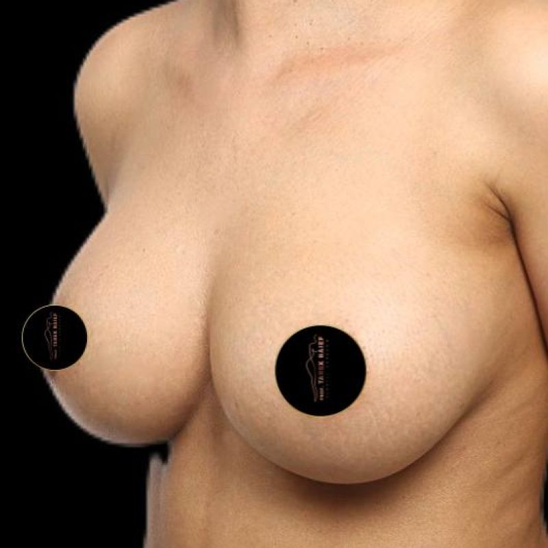 تكبير الثدي 8-2