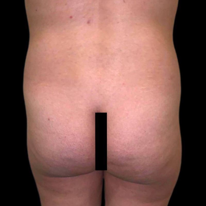 تكبير مؤخرة 1-1