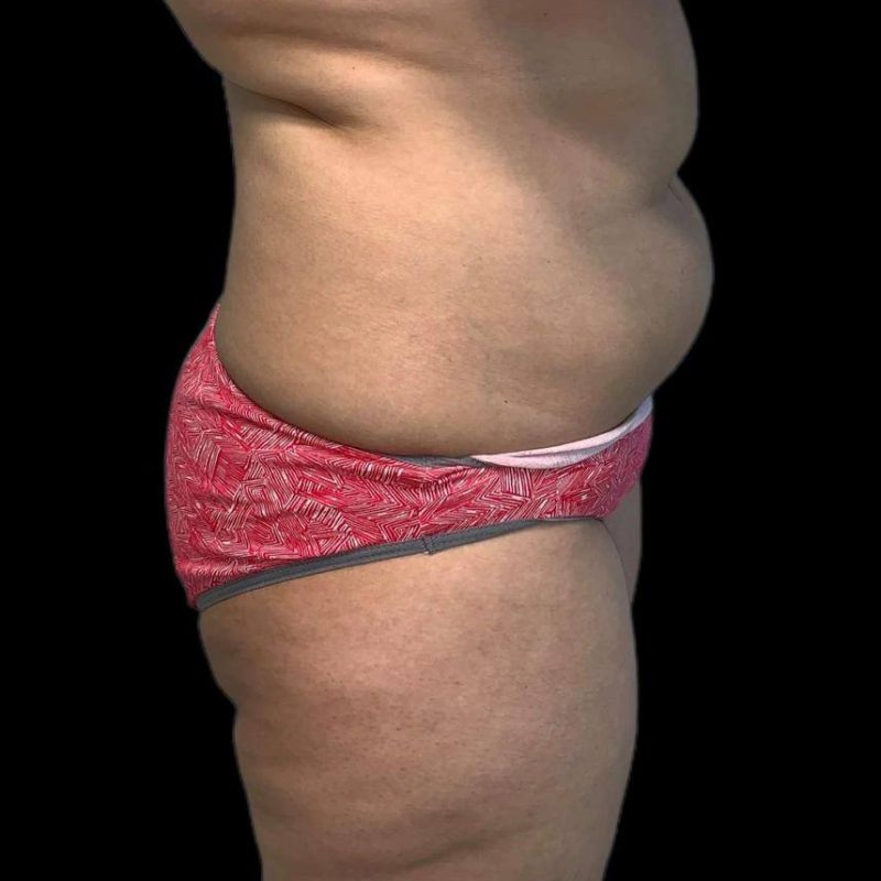 تكبير مؤخرة 2-1