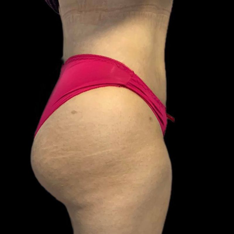 تكبير مؤخرة 2-2