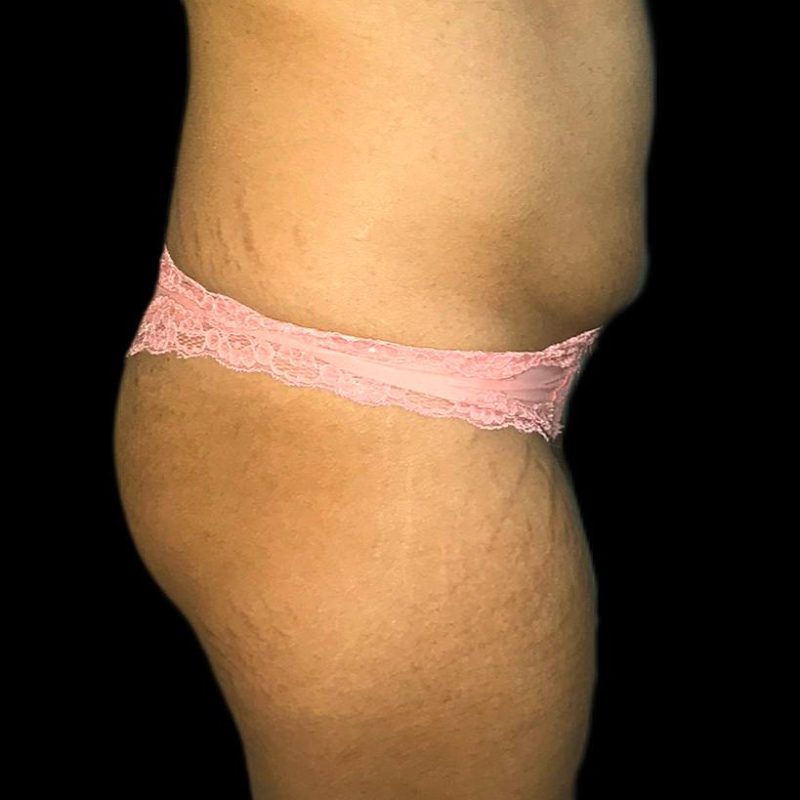 تكبير مؤخرة 3-1