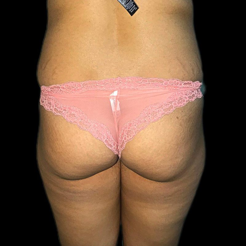 تكبير مؤخرة 4-1