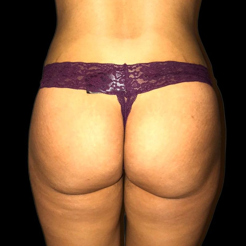 تكبير مؤخرة 4-2