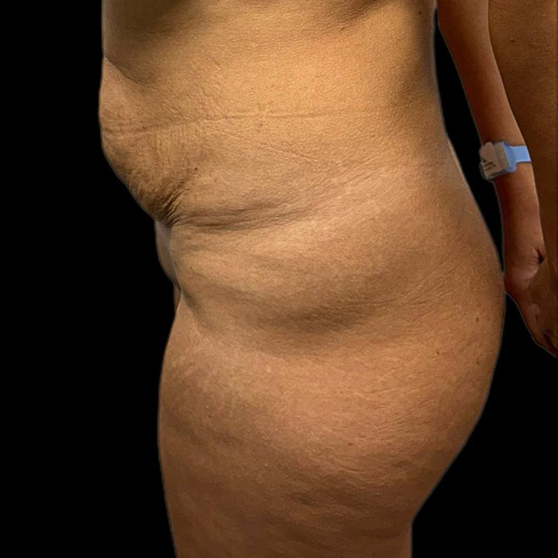 تكبير مؤخرة 6-1