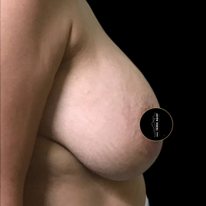 رفع الثدي 1-1