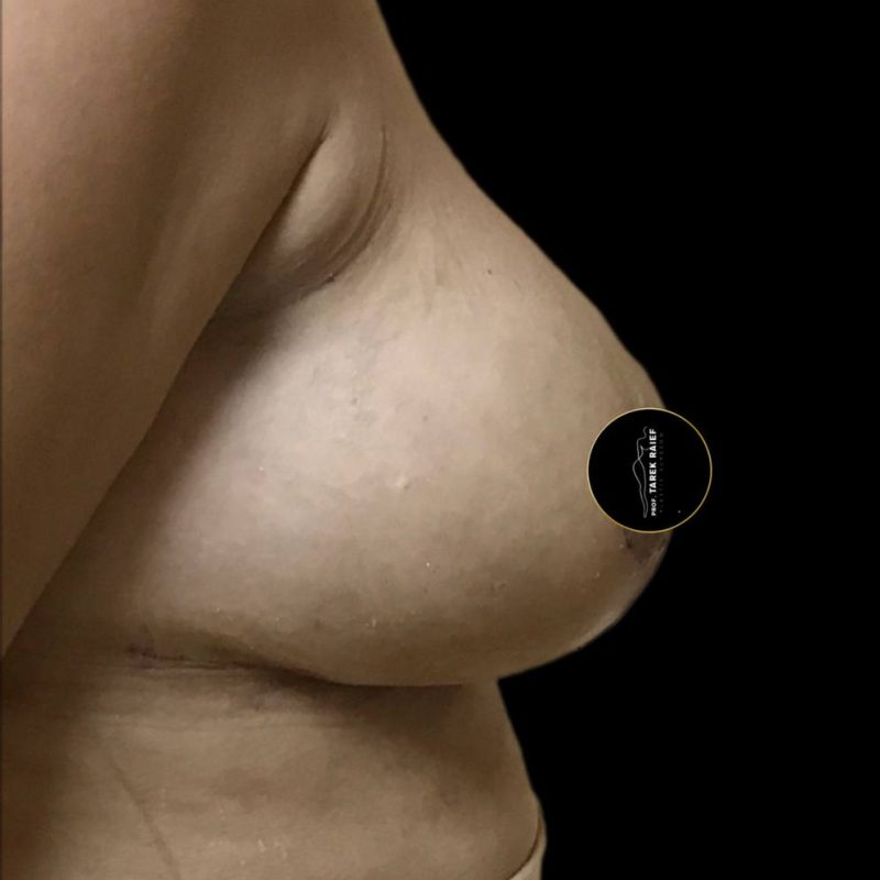 رفع الثدي 1-2