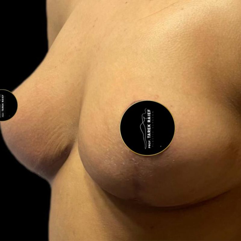 رفع الثدي 2-2