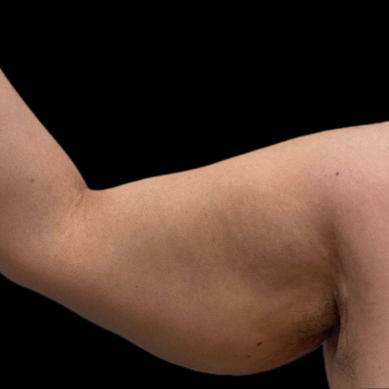 شد الذراعين 1-1