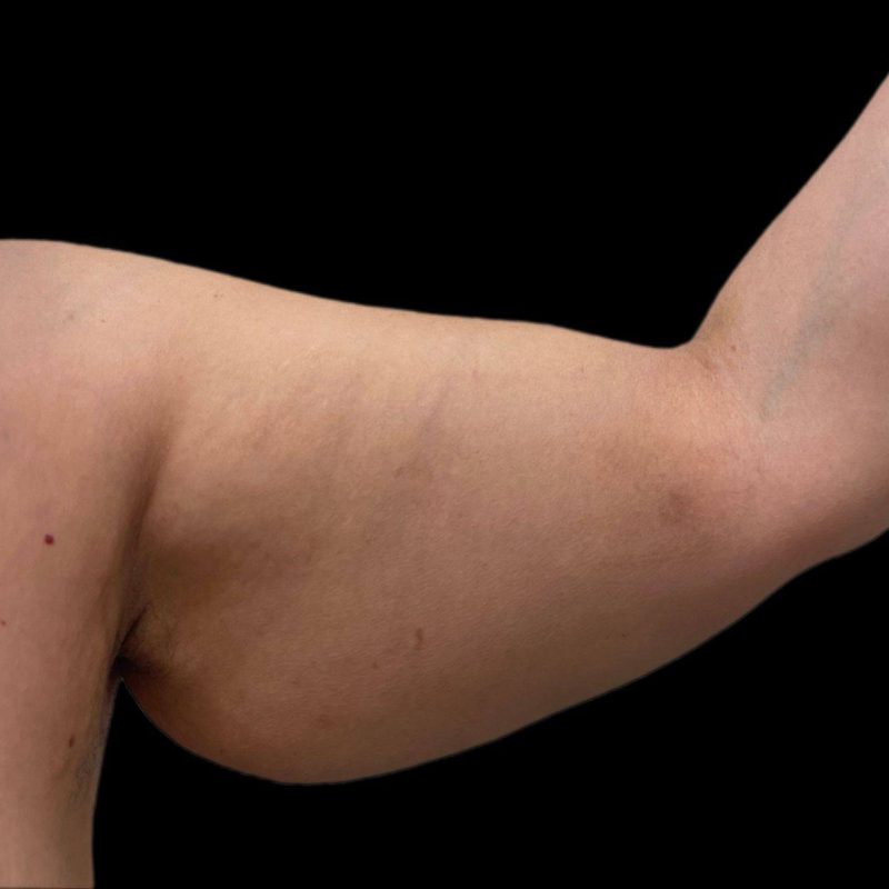 شد الذراعين 2-1