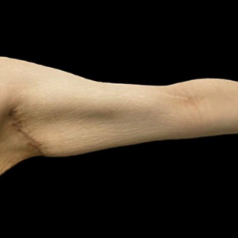 شد الذراعين 2-2